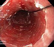 Barrett's Oesophagus on endoscopy