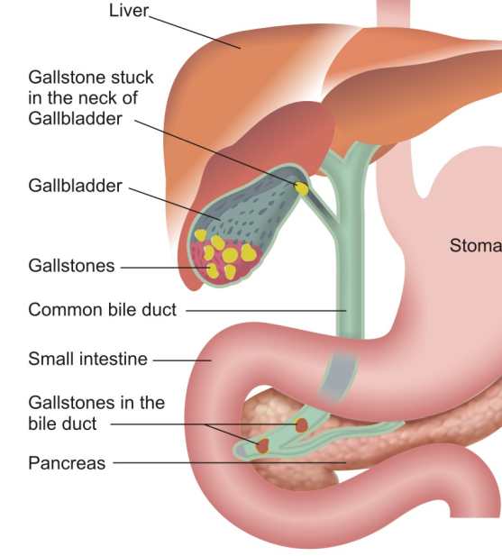 gallstones in the bile ducts