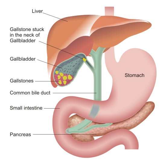 gallstones in the gallbladder