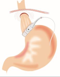 Gastric Band Before Suturing