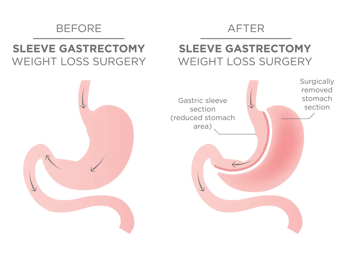 Gastric-Sleeve-Surgery-Sydney