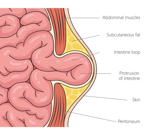 Abdominal wall hernia