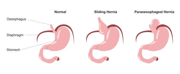 Illustration of different types of hiatus hernia