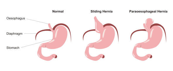 Types of Hiatus Hernias