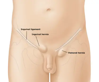 Inguinal and Femoral Hernias