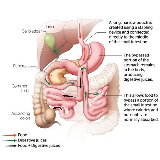 One Anastomosis Gastric Bypass/ Mini Bypass