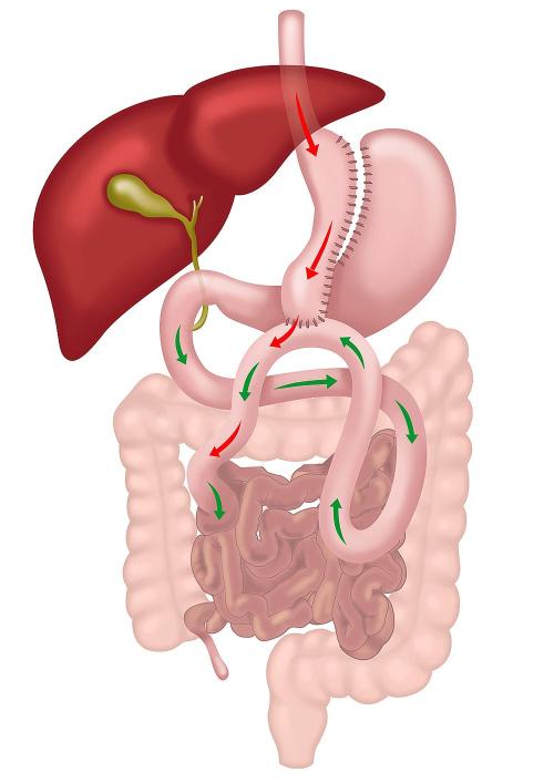 One Anastomosis Gastric Bypass Diagram
