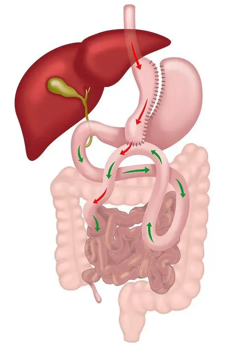 One Anastomosis Gastric Bypass