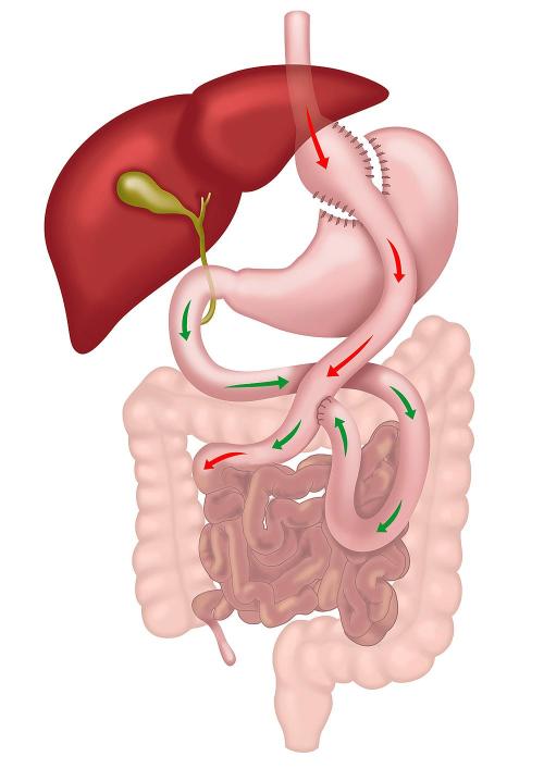 Roux-en-Y Gastric Bypass