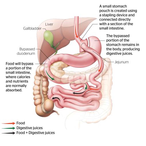 Roux en Y Gastric Bypass Web 18x18