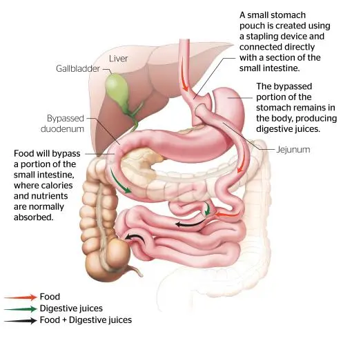 Roux en Y Gastric Bypass