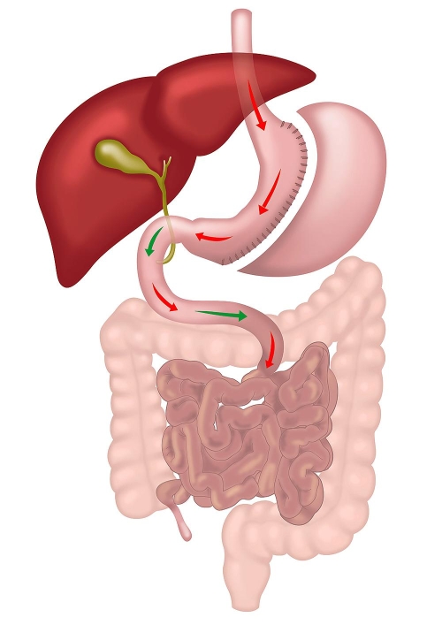 Sleeve Gastrectomy