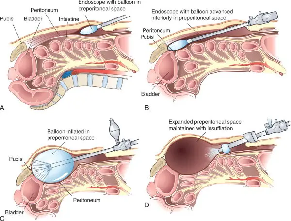 Laparoscopic Inguinal Hernia Repair 