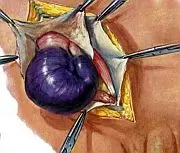 Strangulated Hernia