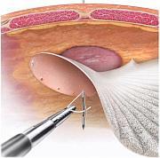 Laparoscopic Repair of Incisional Hernia