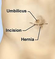 Umbilical Hernia Repair